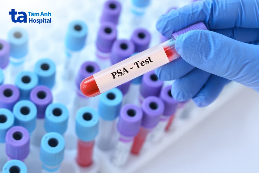 psa test xét nghiệm tái phát ung thư tuyến tiền liệt