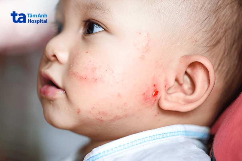 viêm da cơ địa ở trẻ em có tự khỏi được không