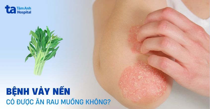 bệnh vảy nến có được ăn rau muống không