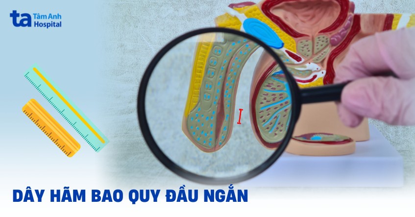 dây hãm bao quy đầu ngắn