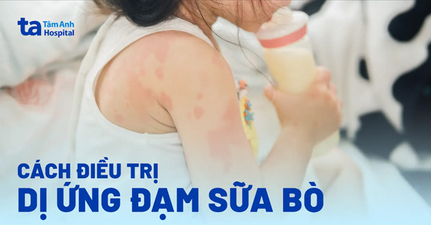 Dị ứng đạm sữa bò là gì?