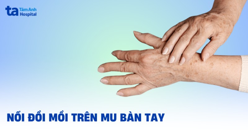 nổi đồi mồi trên mu bàn tay