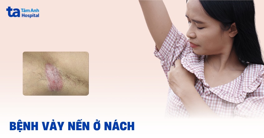 vảy nến ở nách