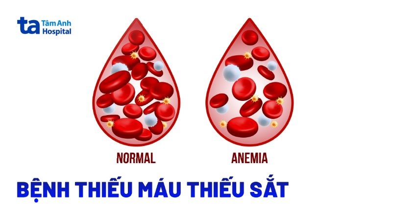 thiếu máu thiếu sắt