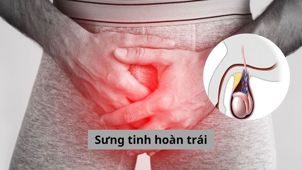 Sưng tinh hoàn trái