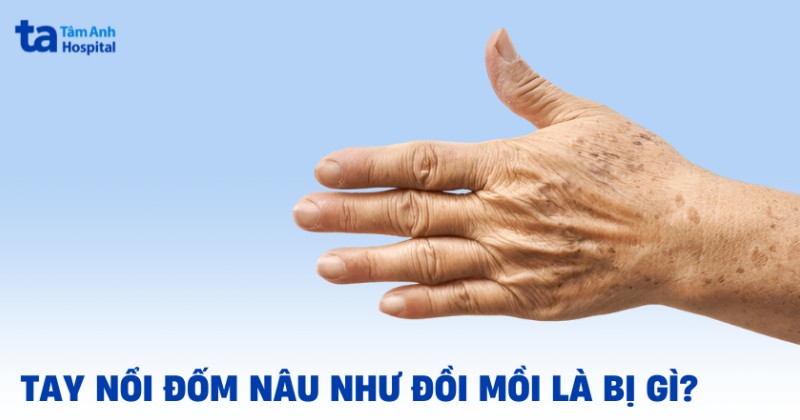 tay nổi đốm nâu như đồi mồi