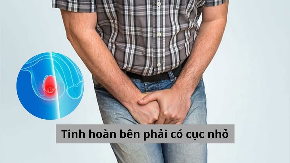 Tinh hoàn bên phải có cục nhỏ