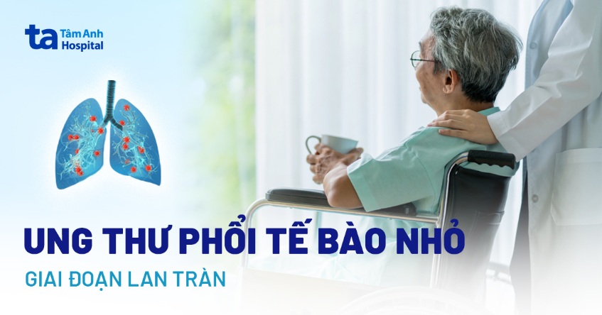 ung thư phổi tế bào nhỏ giai đoạn lan tràn