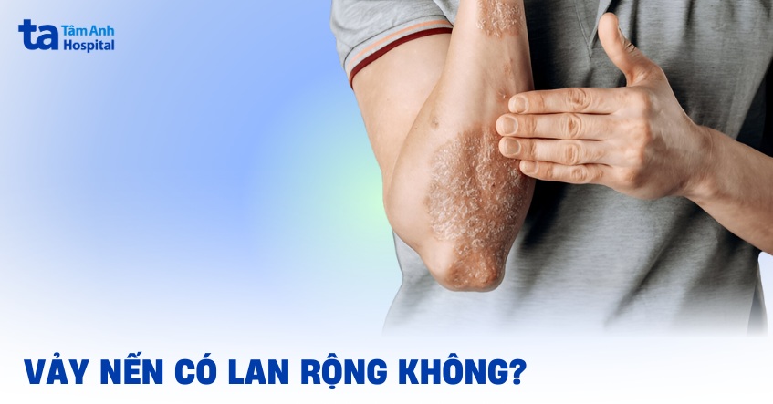 vảy nến có lan rộng không