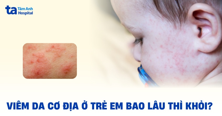viêm da cơ địa ở trẻ em bao lâu thì khỏi