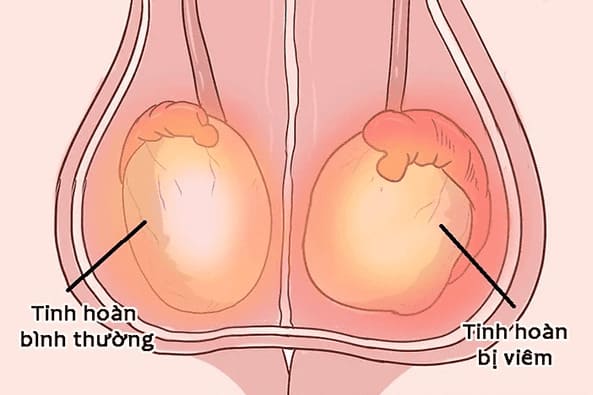Sưng tinh hoàn trái do bị viêm tinh hoàn
