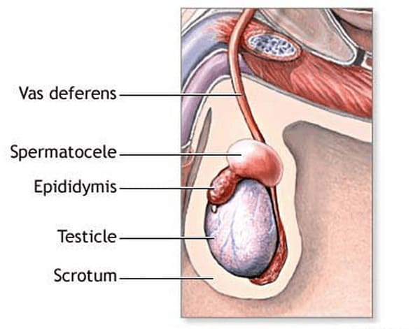 Nang mào tinh (Epididymal Cyst)