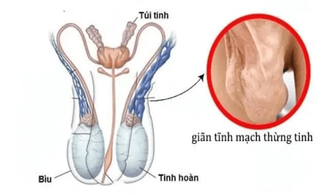 Giãn tĩnh mạch thừng tinh
