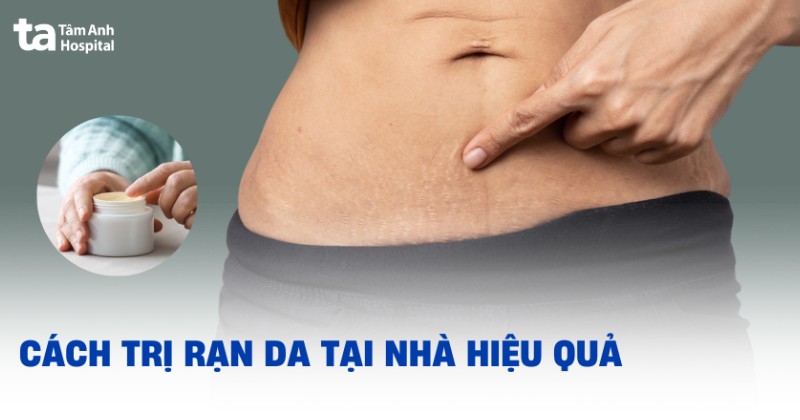 cách trị rạn da