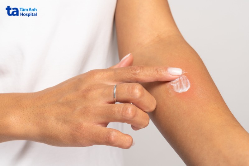 dị ứng mỹ phẩm có thể gây ra rám má
