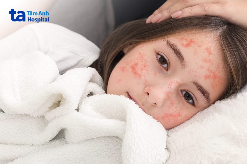 thời gian khỏi sởi không vượt quá 14 ngày