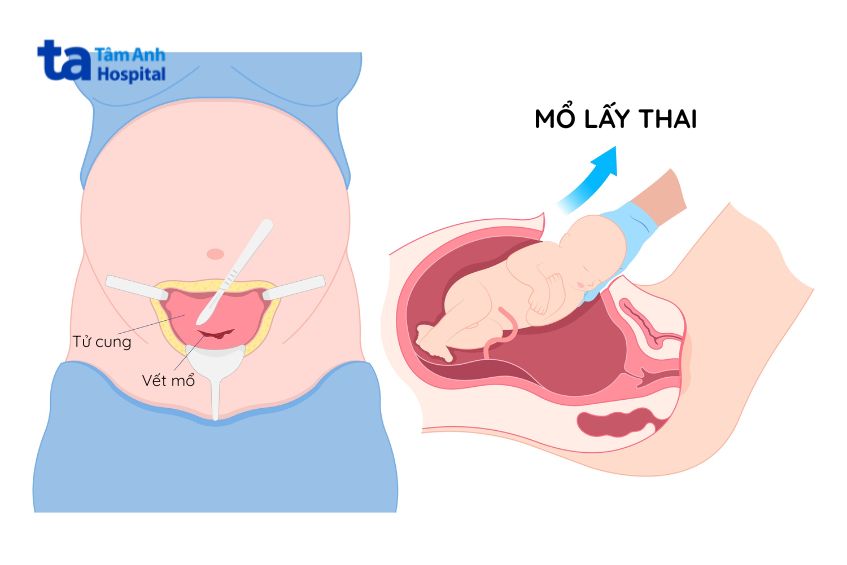 Hình ảnh mô tả phương pháp mổ lấy thai