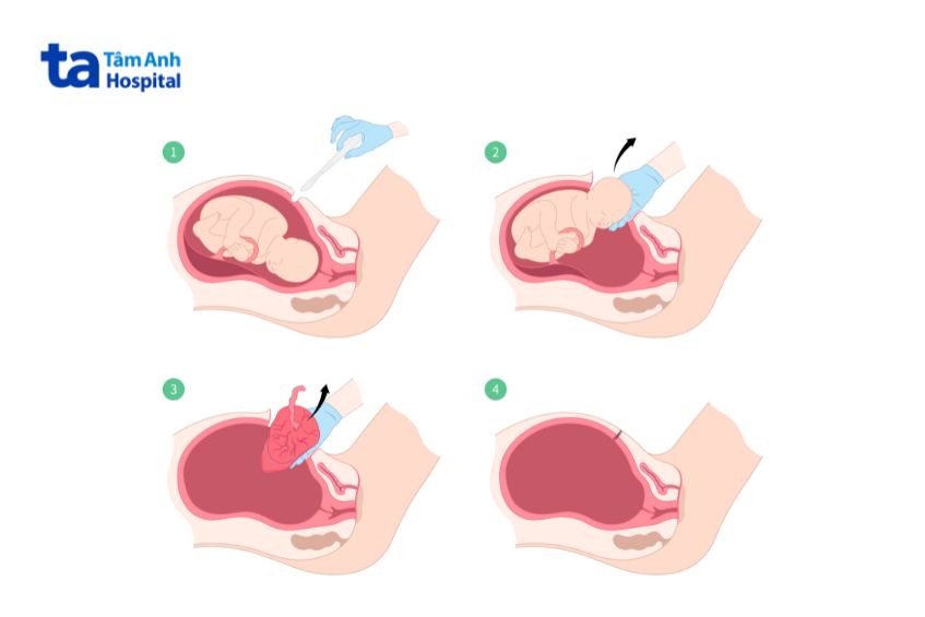 Minh họa quy trình mổ lấy thai nhi