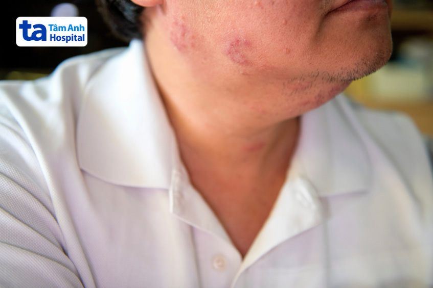 bị zona thần kinh ở mặt