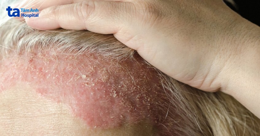 hình ảnh Vảy nến xuất hiện trên da đầu người bệnh