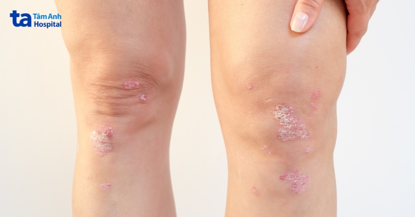 viêm khớp vảy nến gây ra các vấn đề về khớp