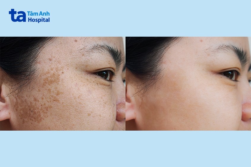 thời gian tan sau khi tiêm meso trị nám
