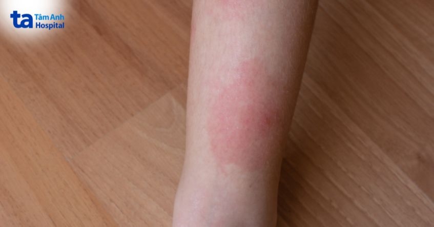 Giai đoạn ủ bệnh ghẻ xốn