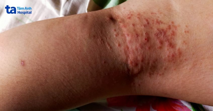 giai đoạn biến chứng ghẻ xốn