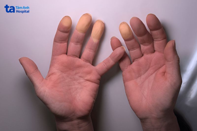 theo dõi biến chứng raynaud