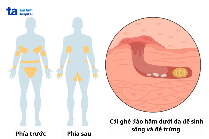 ghẻ ở mông là gì