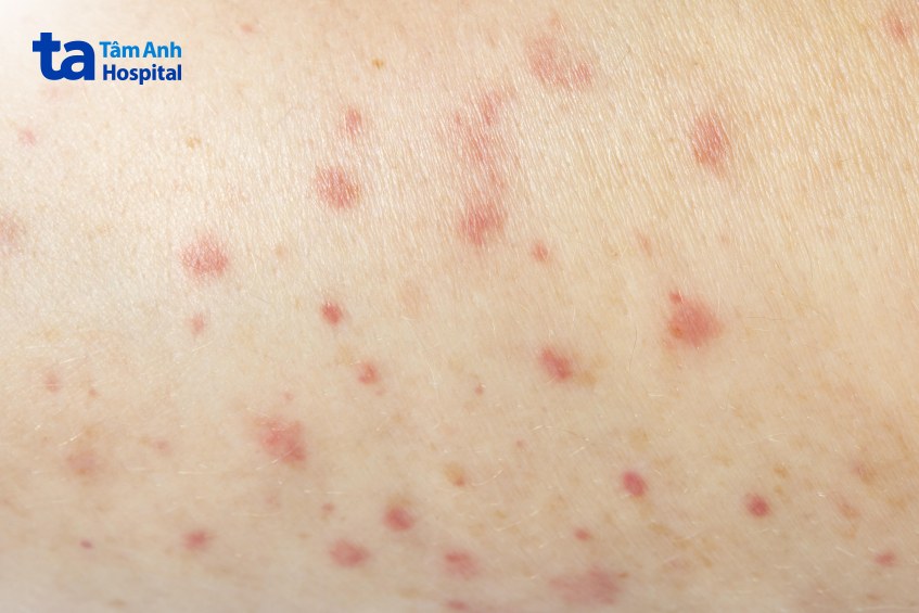 ghẻ có thể để lại vết thâm lâu dù đã điều trị