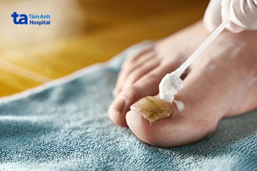 cách chữa trị nấm kẽ móng chân