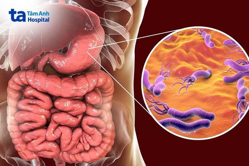 vi khuẩn hp gây viêm loét dạ dày