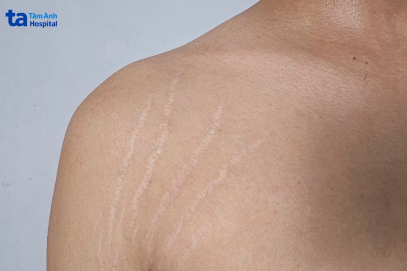 ảnh rạn da xuất hiện ở vai trước