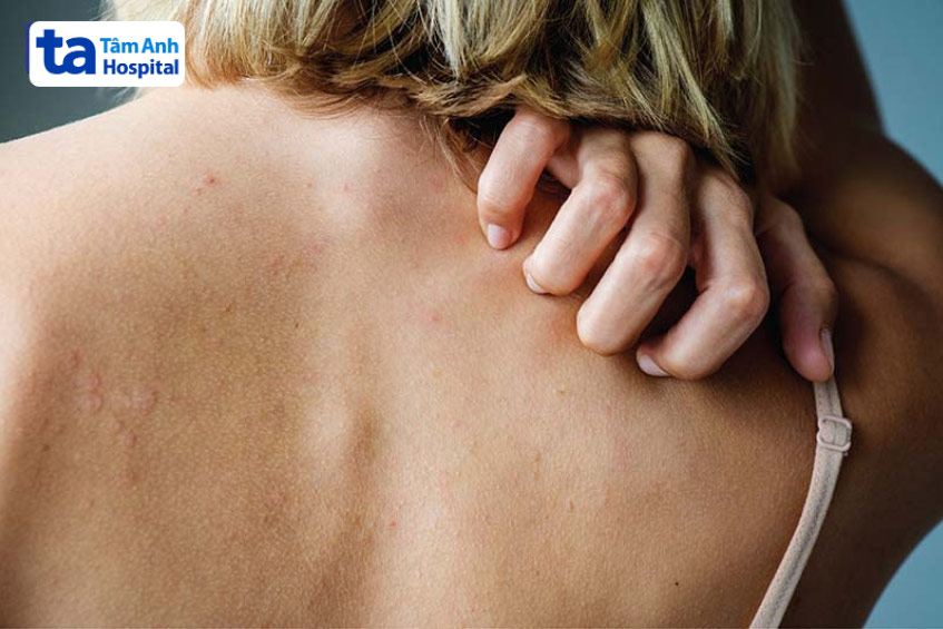 zona gây đau nhức một bên cơ thể