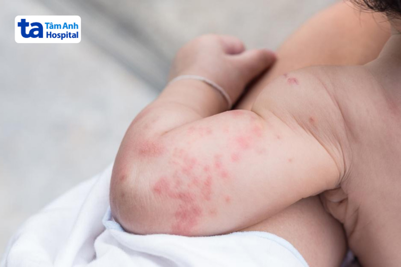 trẻ bị zona thần kinh