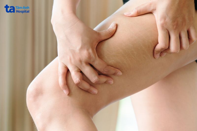 rạn da gây nên vết nứt