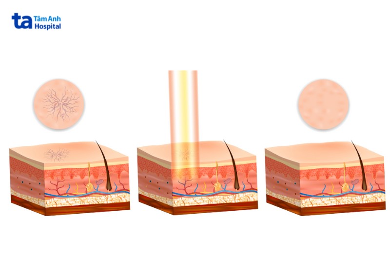 điều trị giãn mao mạch bằng laser