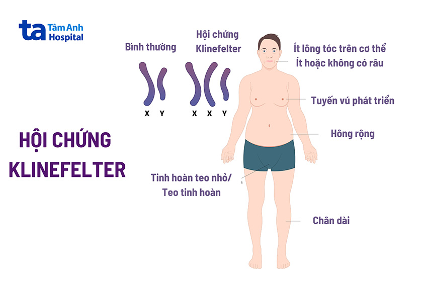 đặc điểm klinerfelter ở nam