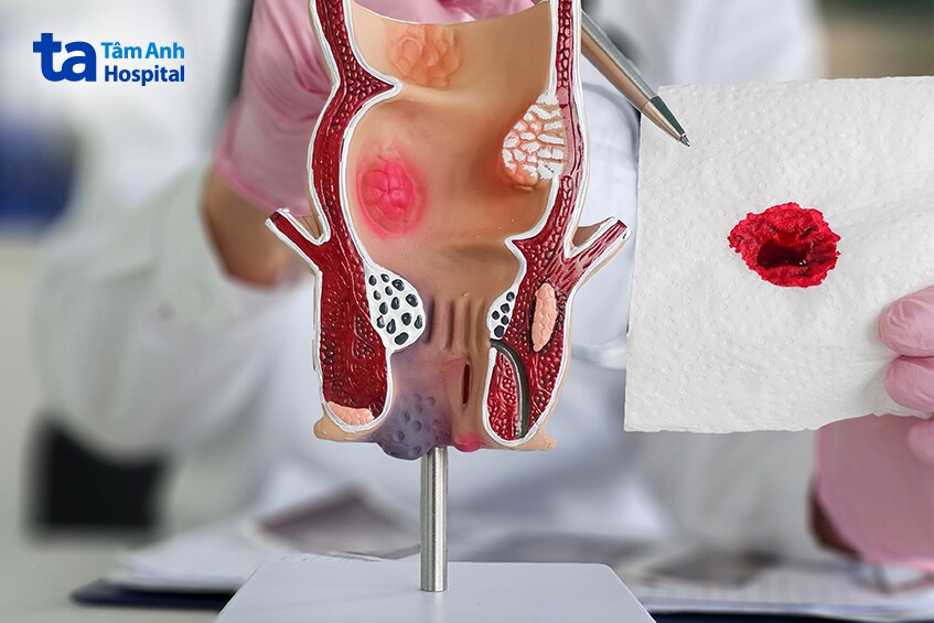 táo bón sau sinh gây chảy máu trực tràng