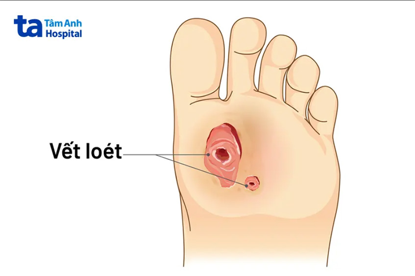Cơ chế chính gây ra loét là do lưu thông máu kém đến da