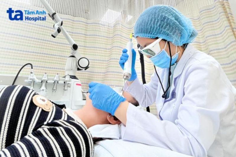 điều trị giãn mao mạch bắn laser 4D