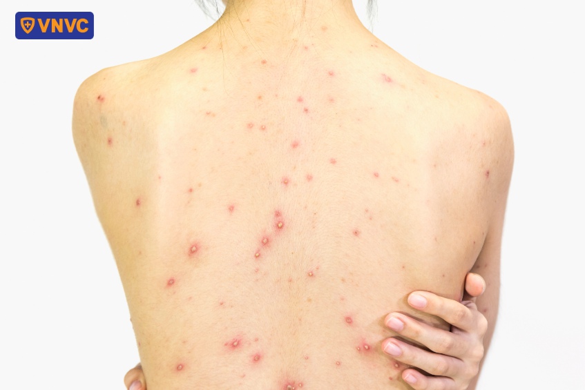 mẹ bầu mắc thủy đậu