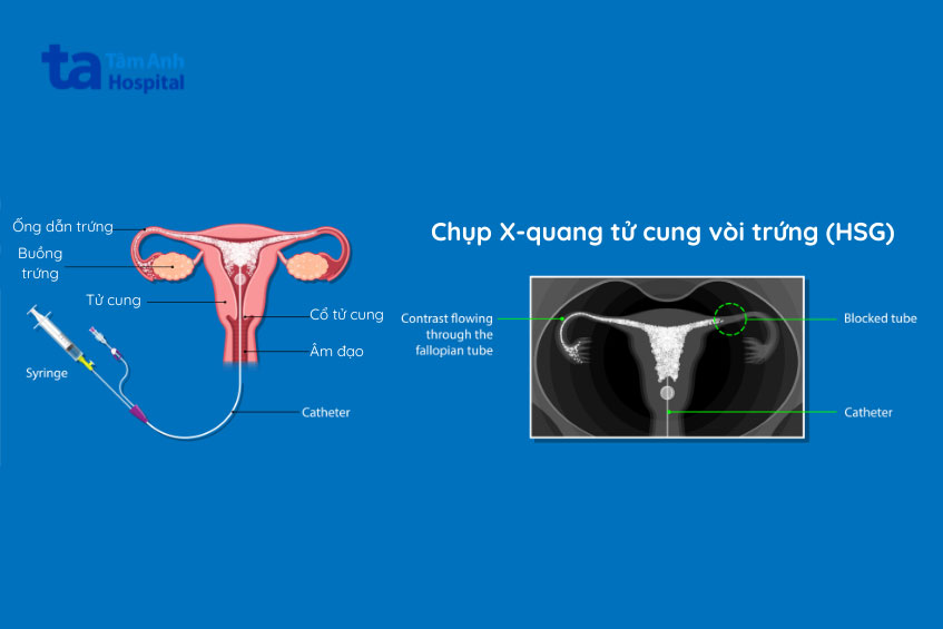 phương pháp chụp x quang tử cung vòi trứng