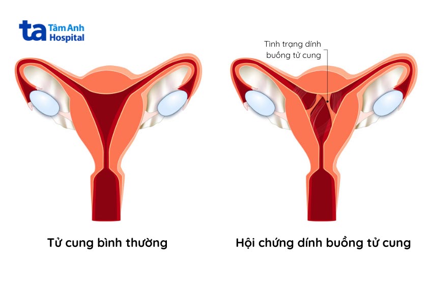 hình ảnh dính buồng tử cung
