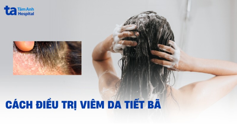 cách điều trị viêm da tiết bã