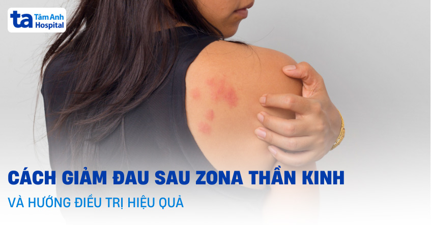 cách giảm đau sau zona thần kinh