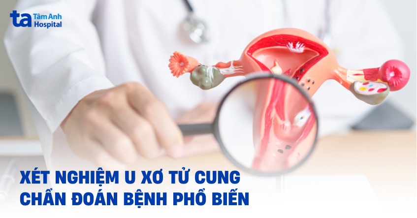 Xét nghiệm u xơ tử cung