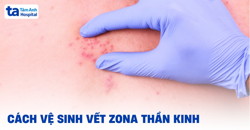 cách vệ sinh vết zona thần kinh