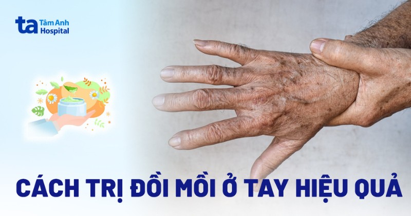 cách trị đồi mồi ở tay